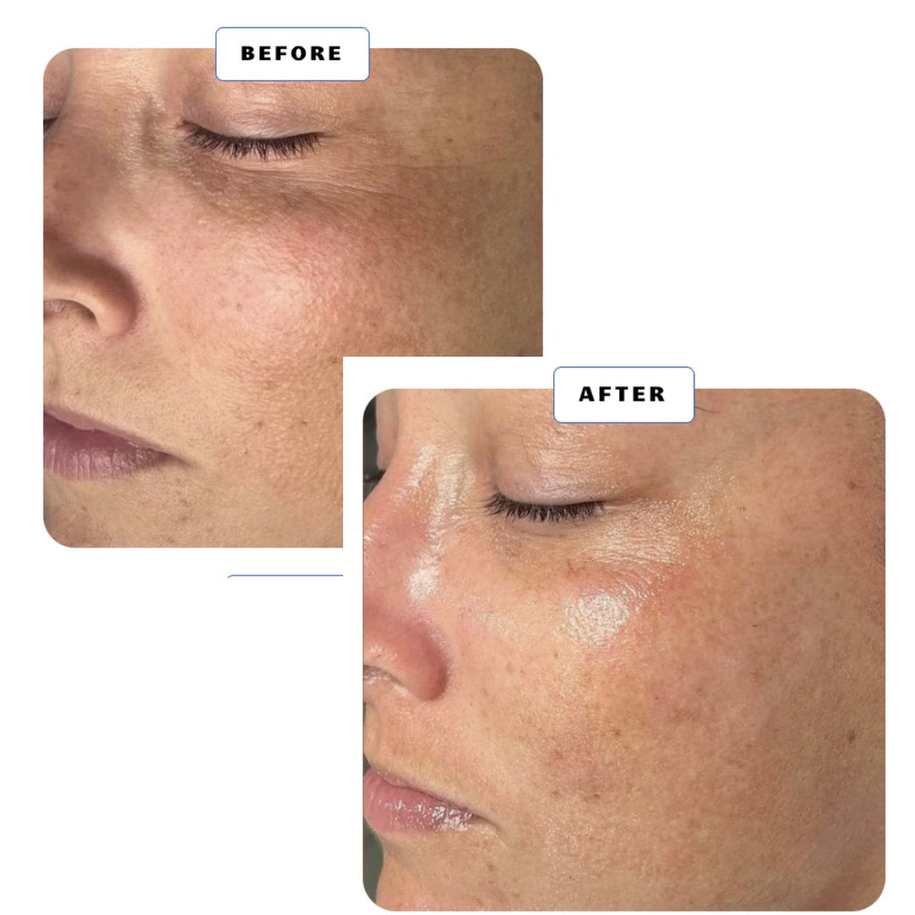 HydraFacial